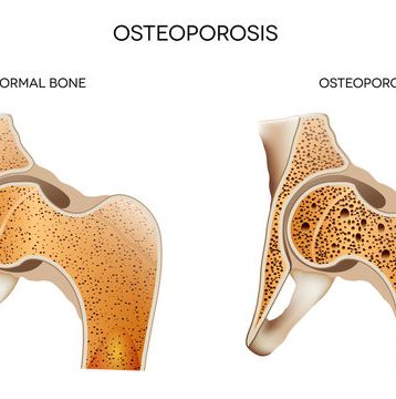 Osteoporosis Unveiled: Risks and Remedies