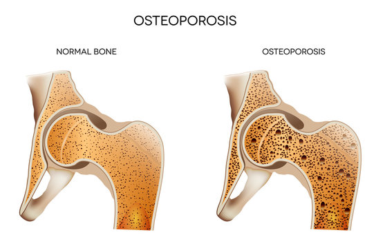 Osteoporosis Unveiled: Risks and Remedies